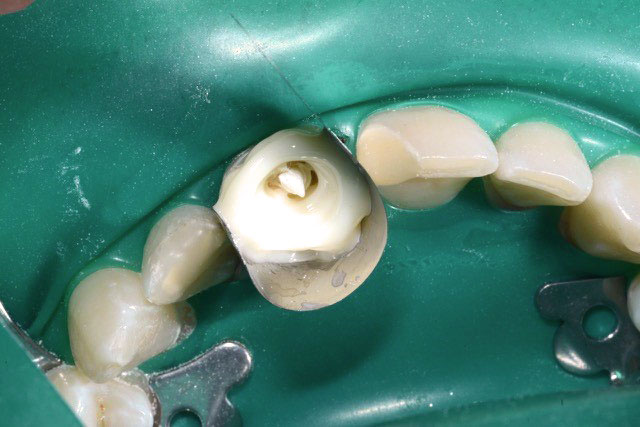endodontische Vorbehandlung