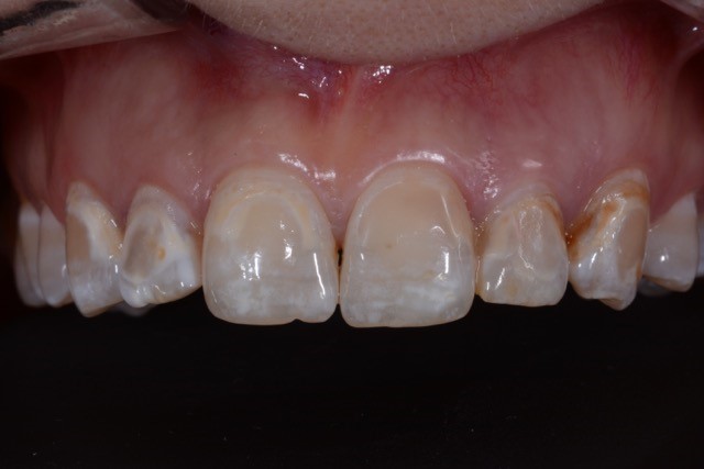 Ästhetische Zahnheilkunde Versorgung mit Kronen Ausgangsbefund
