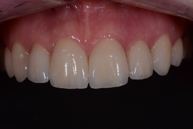 Ästhetische Zahnheilkunde Versorung mit Kronen bei Amelogenisis Imperfekta