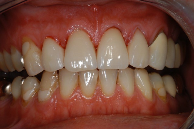 Ästhetische Zahnheilkunde mit Veneers Zustand nach 10 Jahren