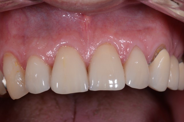 Ästhetische Zahnheilkunde mit Veneers Zustand nach 15 Jahren